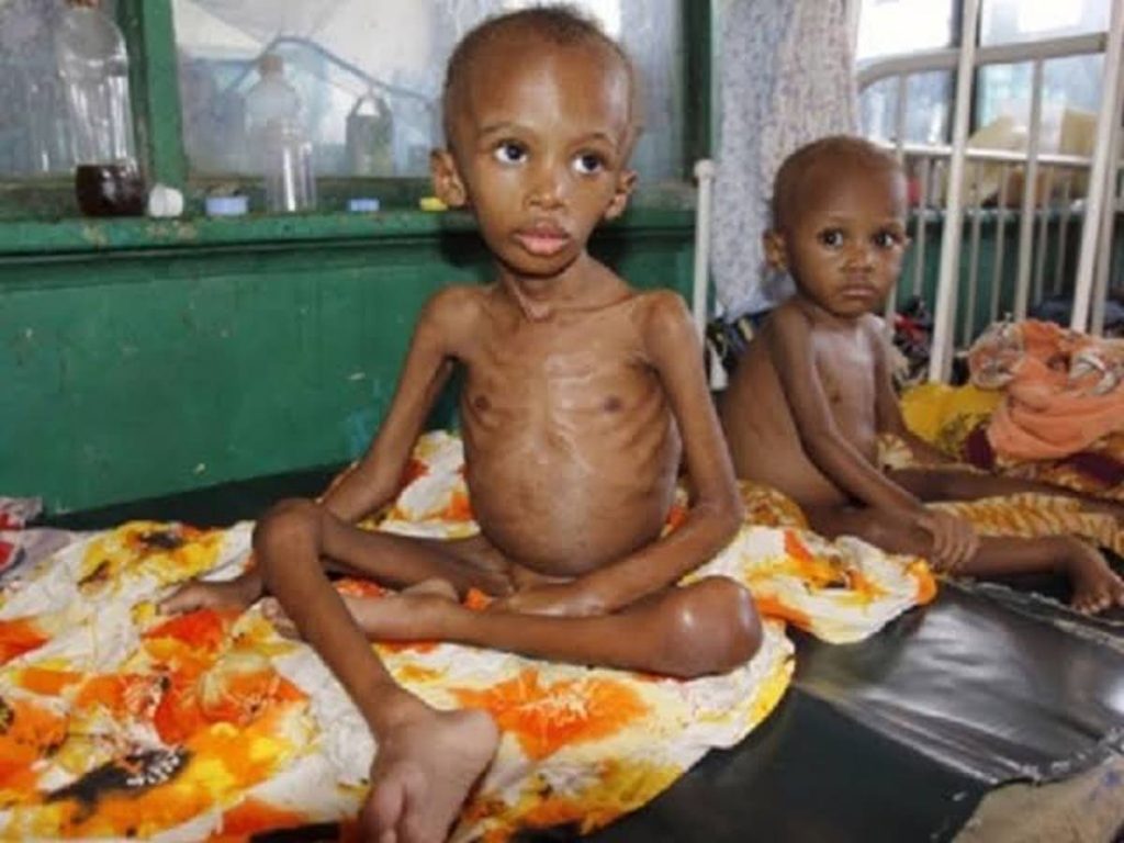 Malnutrition 1 Malnutrition 2