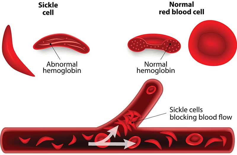 sickle-cell-blood-cells