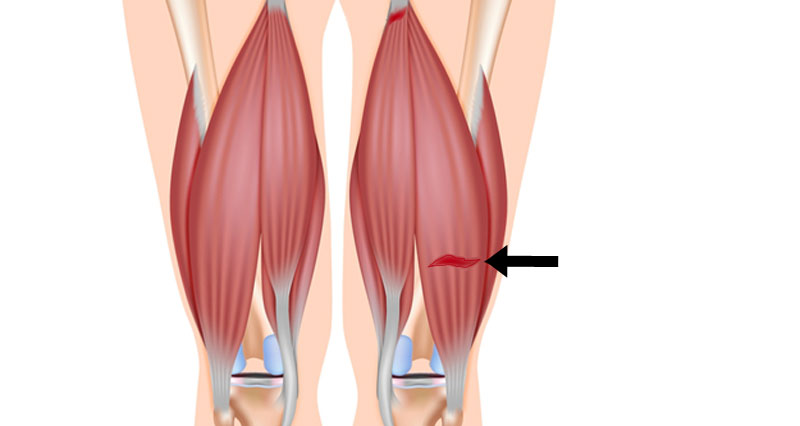 hamstring strain