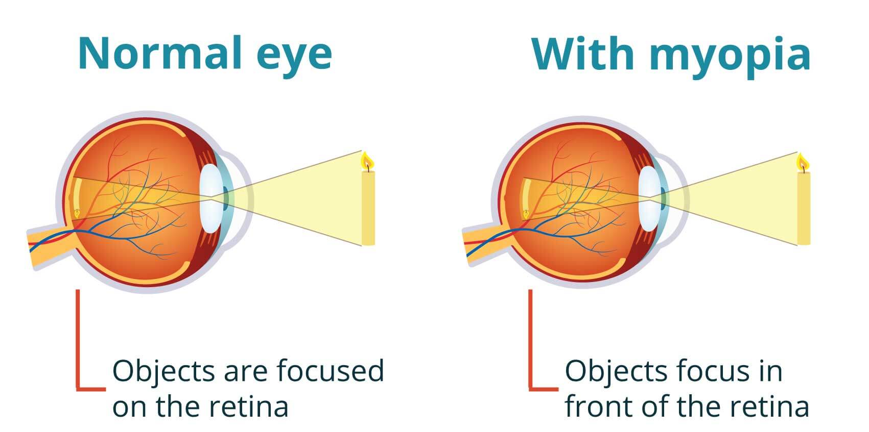 Eye Defects And Corrections | Kofa Study