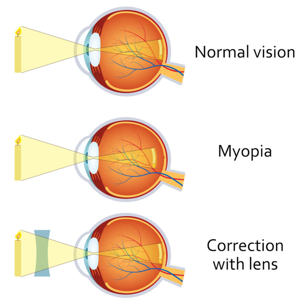 Eye Defects And Corrections | Kofa Study