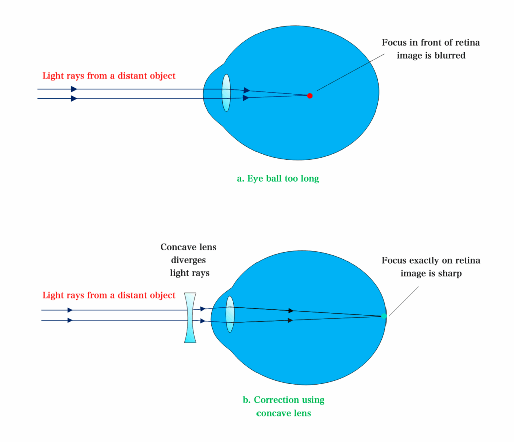 myopia and correction